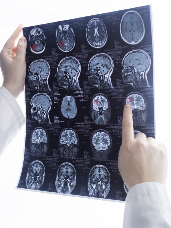 Brain Injury Settlement | Workers Comp Lawyer | Raphael B. Hedwat